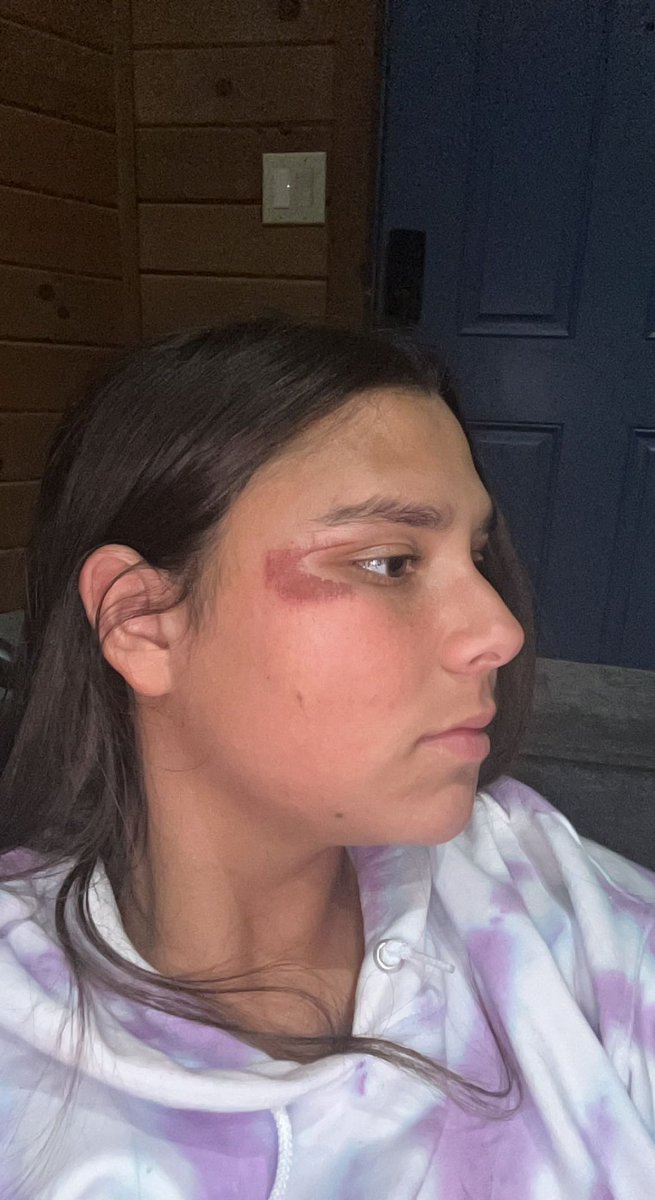MadiEmiller99's tweet photo. Although my face got dragged against the turf it was all worth it for the 2-0 win to ensure our overall win for the showcase. #goalievibes #turfburn #nextlevelsoccer https://t.co/7gzTTyCYvE