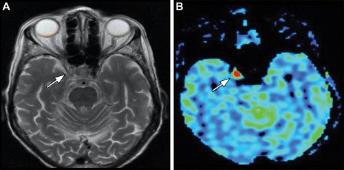 Arterial Spin Labeling: Techniques, Clinical Applications, and Interpretation 

pubs.rsna.org/doi/10.1148/rg…

“authors review the technical and physiologic basis of ASL perfusion, as well as artifacts, pitfalls, and its current clinical applications.“

<a href="/RadioGraphics/">RadioGraphics</a>