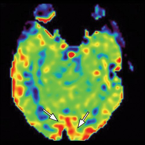 The_ASPNR's tweet photo. Arterial Spin Labeling: Techniques, Clinical Applications, and Interpretation 

https://t.co/QOGIz4Cw9u

“authors review the technical and physiologic basis of ASL perfusion, as well as artifacts, pitfalls, and its current clinical applications.“

@RadioGraphics https://t.co/Jix3ImJUxa