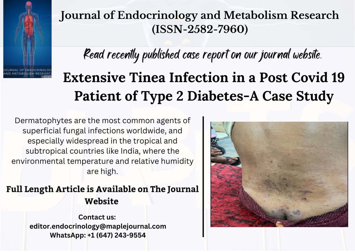 Newly published Case report:
Extensive Tinea Infection in a Post Covid 19 Patient of Type 2 Diabetes-A Case Study
Read full length article here: lnkd.in/gnnHhjAd
#tineainfection #postcovid #diabetes #type2diabetes