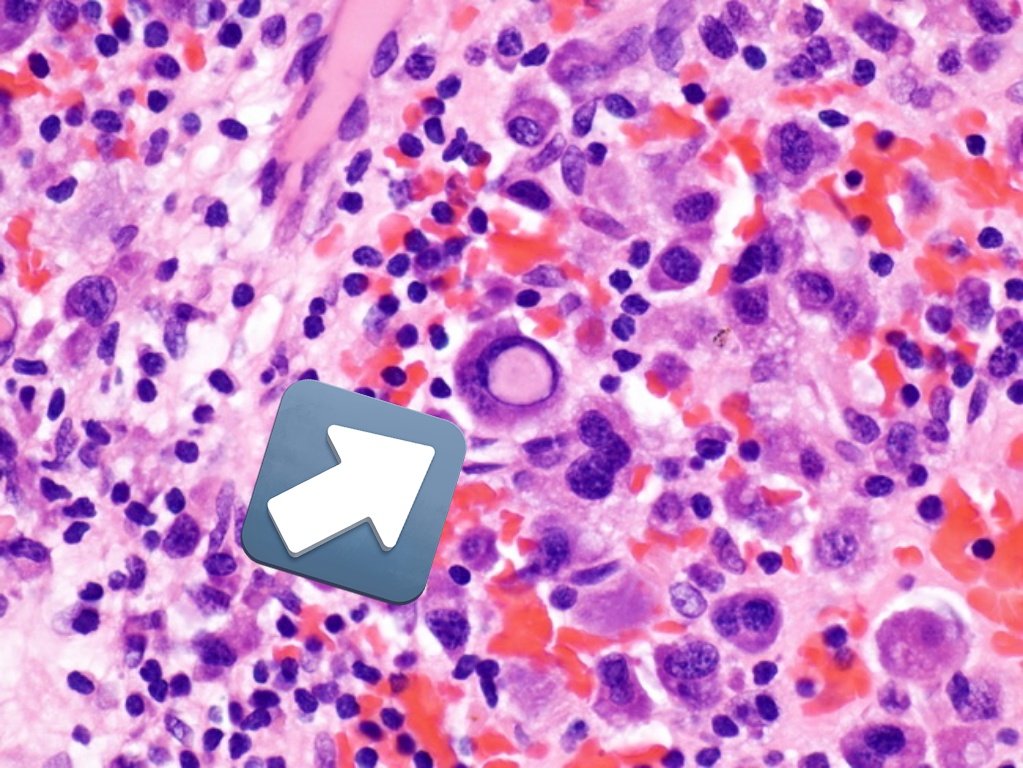 A 65 year old male presented with low urine output and bone pain. On further investigation serum creatinine was high and the patient had low hemoglobin. Bone marrow biopsy showed finding in the image. What is your diagnosis? #pathtwitter #pathtweetorial #pathresidents #pathboards