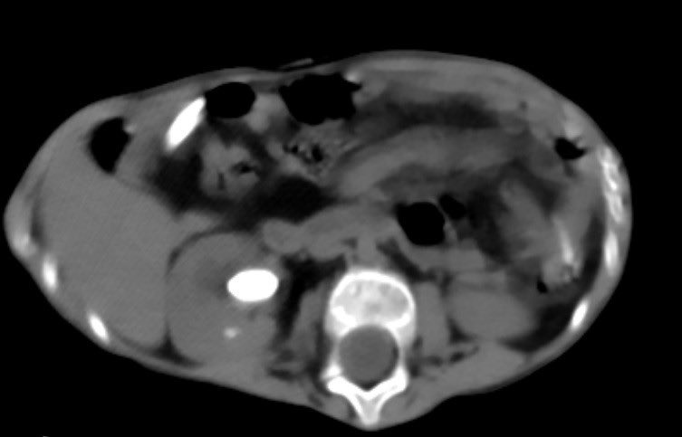 d_dorucu's tweet photo. Pt: 7 yo boy with CP and growth retardation ( 8 kg ) 
15 mm renal pelvic and 5 mm lower pole stones
12Fr/16Fr mini PNL with TFL

Endoscopic and fluoroscopic stone free

with @ytanidir, @Casekerci, Umut Kütükoğlu, @MarmaraUroloji https://t.co/pGMNdXEnoK