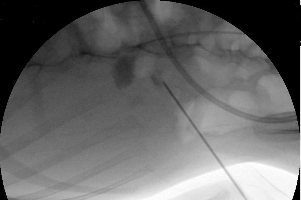 d_dorucu's tweet photo. Pt: 7 yo boy with CP and growth retardation ( 8 kg ) 
15 mm renal pelvic and 5 mm lower pole stones
12Fr/16Fr mini PNL with TFL

Endoscopic and fluoroscopic stone free

with @ytanidir, @Casekerci, Umut Kütükoğlu, @MarmaraUroloji https://t.co/pGMNdXEnoK