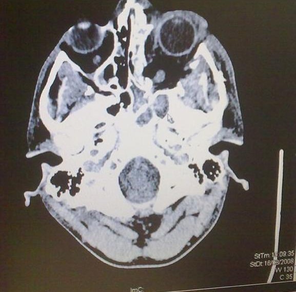 Whowaa's tweet image. One night my life changed. 

I was involved in a RTA

I was given a 4% chance to live

After multiple resuscitations

The Dr saved my life

And then proceeded to neglected me (botched operations) check bio 👀

For years I&apos;ve been miss treated and told to take these pills.