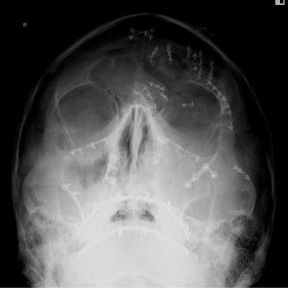 Whowaa's tweet image. One night my life changed. 

I was involved in a RTA

I was given a 4% chance to live

After multiple resuscitations

The Dr saved my life

And then proceeded to neglected me (botched operations) check bio 👀

For years I&apos;ve been miss treated and told to take these pills.