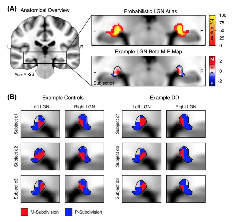 FriedericiLab's tweet photo. 🆕📰New preprint by @MullerAxt, @LKauffmann_LPNC, @CornEichner &amp; @kvonkriegstein (colab. w/ @TUD_Science).

Leveraging #7T #fMRI to investigate functional responses of the lateral geniculate nucleus #layers in #dyslexia: https://t.co/E9CEb6bDeg

#neuroscience #subcortex #thalamus https://t.co/ZJ5TVeDn9S