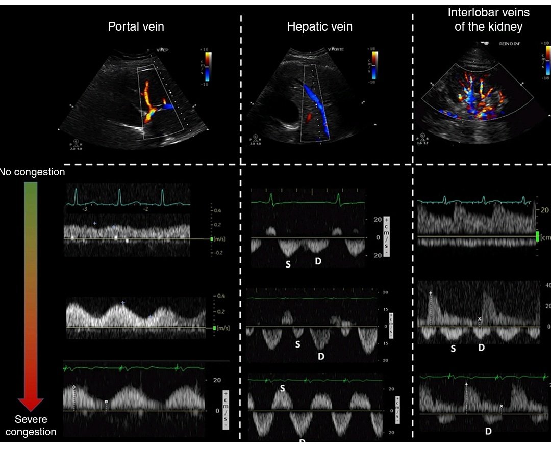 NefrarC's tweet photo. POCUS👨🏽‍⚕️ en evaluación del paciente con terapia de remplazo renal🌊🌊🌊, puede guiarnos sobre volúmenes de ultrafiltración💦 y evitar intervenciones erradas que desencadene alteración hemodinámica🫀🫁🧠
Útiles:
Líneas B☄️
VCI🔘
VEXUS〰️
DERRAME PLEURAL🦇
DOI 10.34067/KID.0002822022 https://t.co/w75uhq0gSj