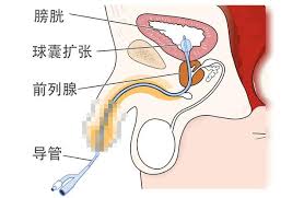 #前列腺高潮  #前高技巧  
前列腺高潮快速获得快感方法4:马眼棒刺激。重点要说的是这可能有很大的受伤风险和感染风险，谨慎参考。马眼棒有很多类型，针对前列腺刺激选择坚硬的，能很好刺激前列腺，由于此操作是直接性真正接触性的抵达前列腺，所以快感度会很直接，尽管如此，还是不建议去玩以安全第一 https://t.co/P3mqcUR5ZI