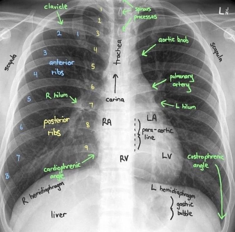 md1talk's tweet photo. 📍صور تحتاج تشوفها وتتعود عليها زين 👌🏻🌟

Chest X ray 🫁 https://t.co/a4OM3I2Hke