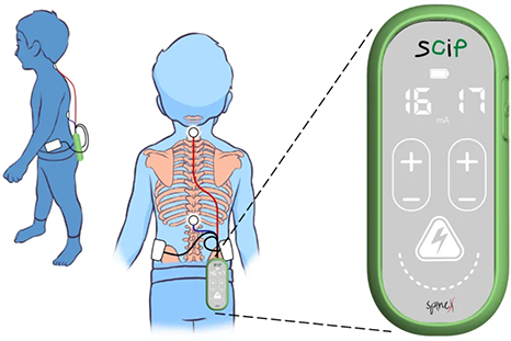 Non-Invasive Spinal Modulation for Cerebral Palsy

SpineX, a medtech company based in California, has developed the Spinal Cord Innovation in Pediatrics (SCiP) device, a non-invasive spinal cord neuromodulation technology that is intended to treat c…
medgadget.com/?p=1538975&utm…