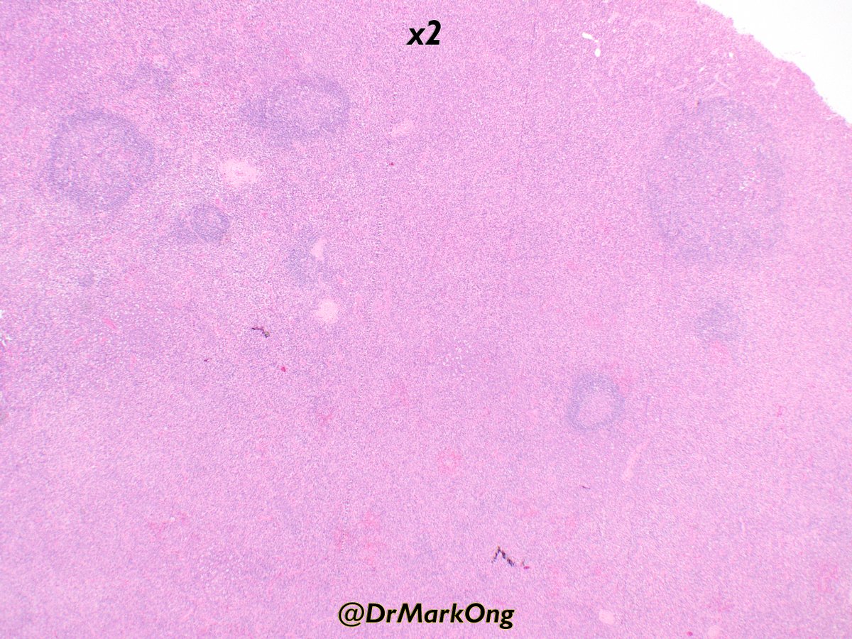 DrMarkOng's tweet photo. Neck lymph node in an elderly person. Very difficult case which needed lots of IHC.

Follicles widely separated by collections of medium-sized cells. Some IHC in next tweet.

What other IHC would you like to see and what's the unifying diagnosis?

#hemepath https://t.co/vWaCttx1pN