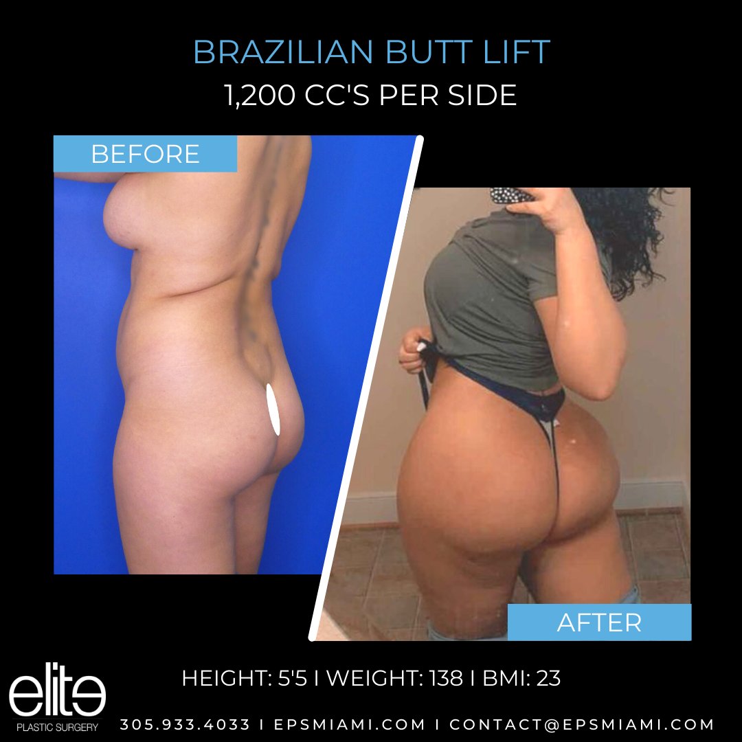 EPSMiami's tweet photo. This Elite Queen got some beautiful curves with her #brazilianbuttlift by Dr! She is body goals!
π» https://t.co/zRKQqiKfhd
π 305.933.4033
π§ contact@epsmiami.com
#BBL #buttaugmentation #bodysculpting #bodycontouring #plasticsurgery #miamiplasticsurgery #miami https://t.co/Y5neToxplC