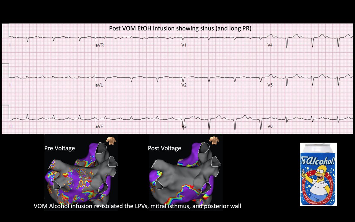 We hoped this would happen but did not expect it...termination of left atrial flutter during VOM ethanol infusion. Hopefully it helps this patient. Nice maps @ryancolemaps @maddyferraro1 @arcampado @MiguelVldrbno @TJHeartFellows