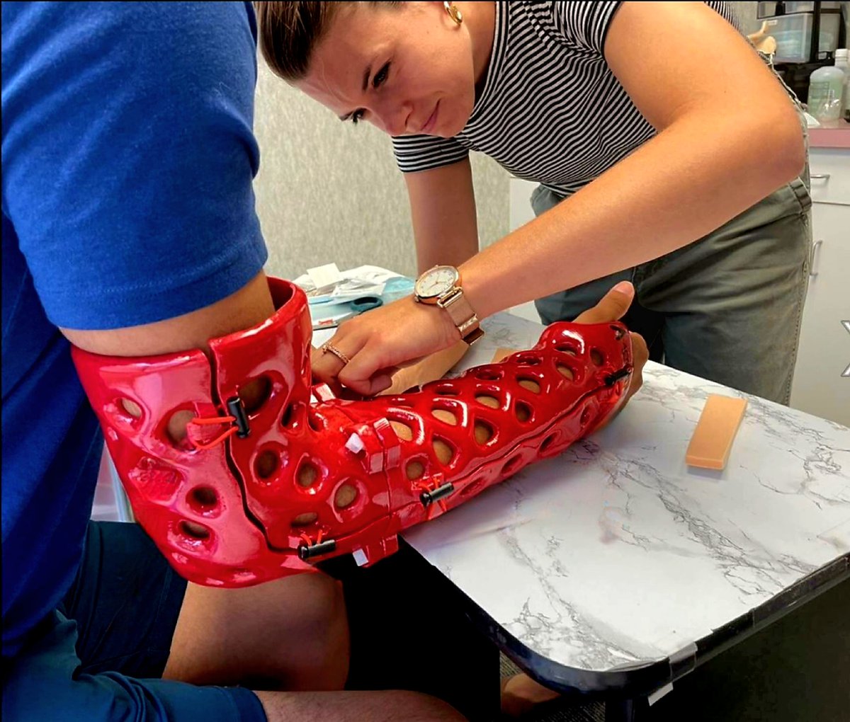 ActivArmor's tweet photo. "This Displaced radius shaft fracture occurred in this 16 year old heavy weight wrestler competing in a national tournament in North Dakota . Internal fixation accomplished with ACCUMED and than stabilized with #ActivArmor for the win. #followthered
#accumed #waterproofcast https://t.co/ZR0CPBI2Ko