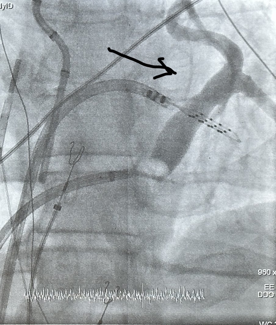 epdocwidguitar's tweet photo. Alcohol Ablation at Saint Francis Hospital, Hartford, CT Thanks @haseebqazi for your help. Lateral isthmus toasted. @TK61275 (awesome mapping), @jdellorf, @WillGion, @tri @HomoudMunther #epeeps https://t.co/tN3Rq6WwXm