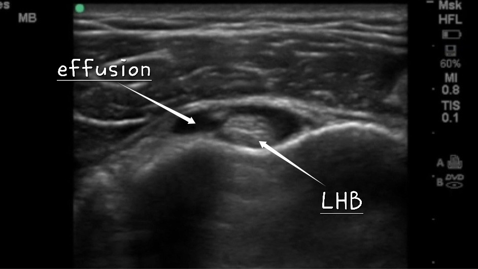 🏵Indirect signs of a Frozen Shoulder on Ultrasound🏵

1. Long head of biceps effusion (most common)