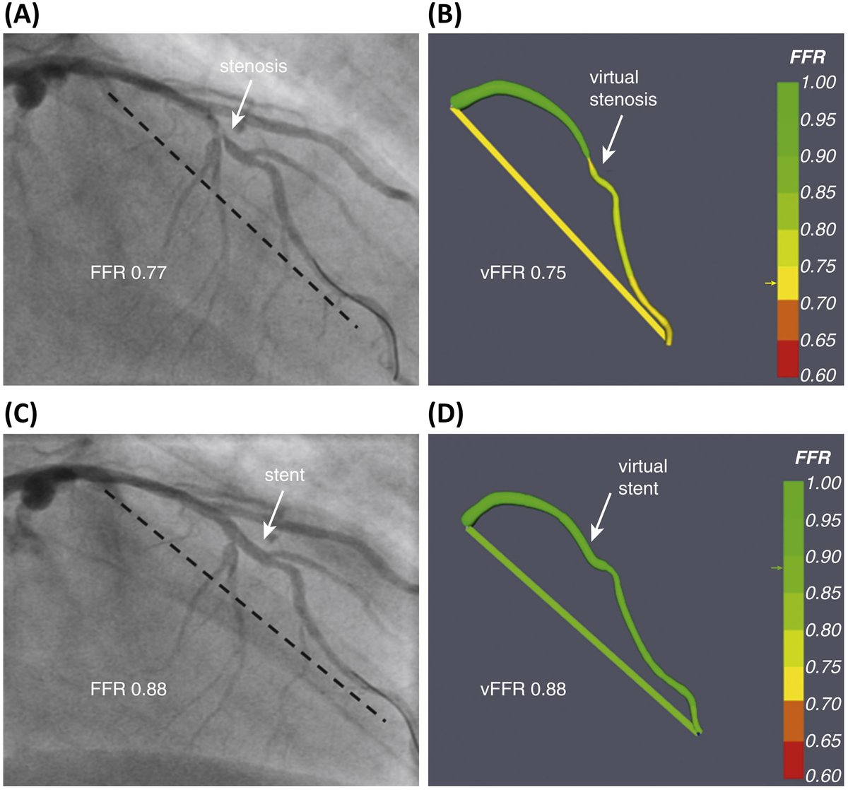 RCMjournal's tweet photo. #RCM - Vol. 23 No. 11
🏝️Review
Current and Future Applications of Computational Fluid Dynamics in Coronary Artery Disease
@alecandreva @MaurizioRizzini @DeNiscoGiuseppe @Fabri84Dascenzo @Udio_NT
#CAD #ComputationalFluidDynamics #CFD #Coronary
Full text:
https://t.co/ZP5vsuHEfj https://t.co/QrQdgBN0SR