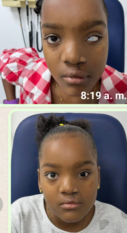 jhvargas2020's tweet photo. Nos comprometimos y cumplimos, la niña Emely de Domingodó municipio #ElCarmenDelDarién en el Chocó, fué rehabilitada facialmente gracias a la solidaridad de muchas personas. @interquirofanos @CMarquezCadavid @SaludAntioquia #ItalLent #VisionBlue #DraHilianaHerrera #HogarSanJosé https://t.co/G4742Eymjx