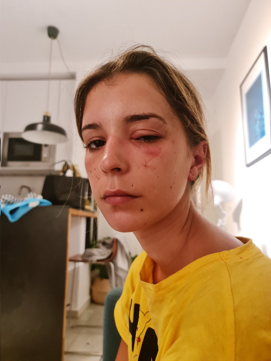 RojasEngein's tweet photo. A mi novia le salió un orzuelo y no desaproveche la oportunidad https://t.co/BwxMUJ13pk