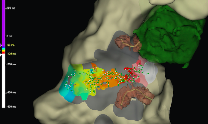 Rodolfo San Antonio (@dr_sanantonio) on Twitter photo Challenging scar VT case with focal breakout from basal IV septum in nonischemic CMP. The area of interest is close to the SR mapping of conduction system. What would be your approach? <a href="/Laia_Garrido_V/">Laia Garrido</a> <a href="/Pau79_EP/">Paolo D. Dallaglio</a> <a href="/ADAS3D/">ADAS3D Medical</a> <a href="/AbbottNews/">Abbott</a> <a href="/EPeeps_Bot/">EP_Bot</a> Challenging scar VT case with focal breakout from basal IV septum in nonischemic CMP. The area of interest is close to the SR mapping of conduction system. What would be your approach? <a href="/Laia_Garrido_V/">Laia Garrido</a> <a href="/Pau79_EP/">Paolo D. Dallaglio</a> <a href="/ADAS3D/">ADAS3D Medical</a> <a href="/AbbottNews/">Abbott</a> <a href="/EPeeps_Bot/">EP_Bot</a>