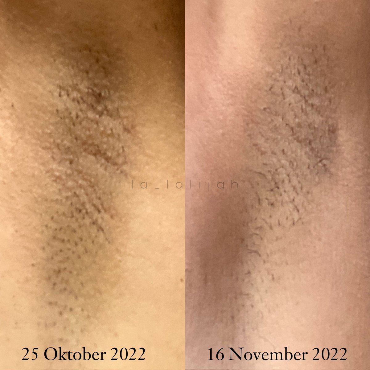 ⚠️ Ketiak tidak mulus ⚠️

Kirain viral doang, ternyata pas nyobain bagus juga🥲❤  Puji Tuhan ngefek sekeliatan itu🥺 Harganya under 100k!!

—cek reviewnya dibawah♡~ #racuninbodycare