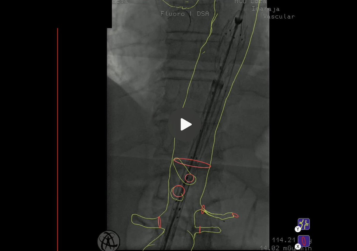 Vascupedia_com's tweet photo. New #recordedcase @ @Vascupedia_com
Treatment of an 83mm juxtarenal aortic aneurysm
https://t.co/jVoln7O2IM
Gabriel C. Inaraja Pérez 🇪🇸
More information about @CydarMedical:
https://t.co/zJHN4A5Gik
@farkomd @DrAliAzizzadeh @AWBeckMD
#AI #AAA #AortaED #BEVAR https://t.co/yHBzeqTWQd