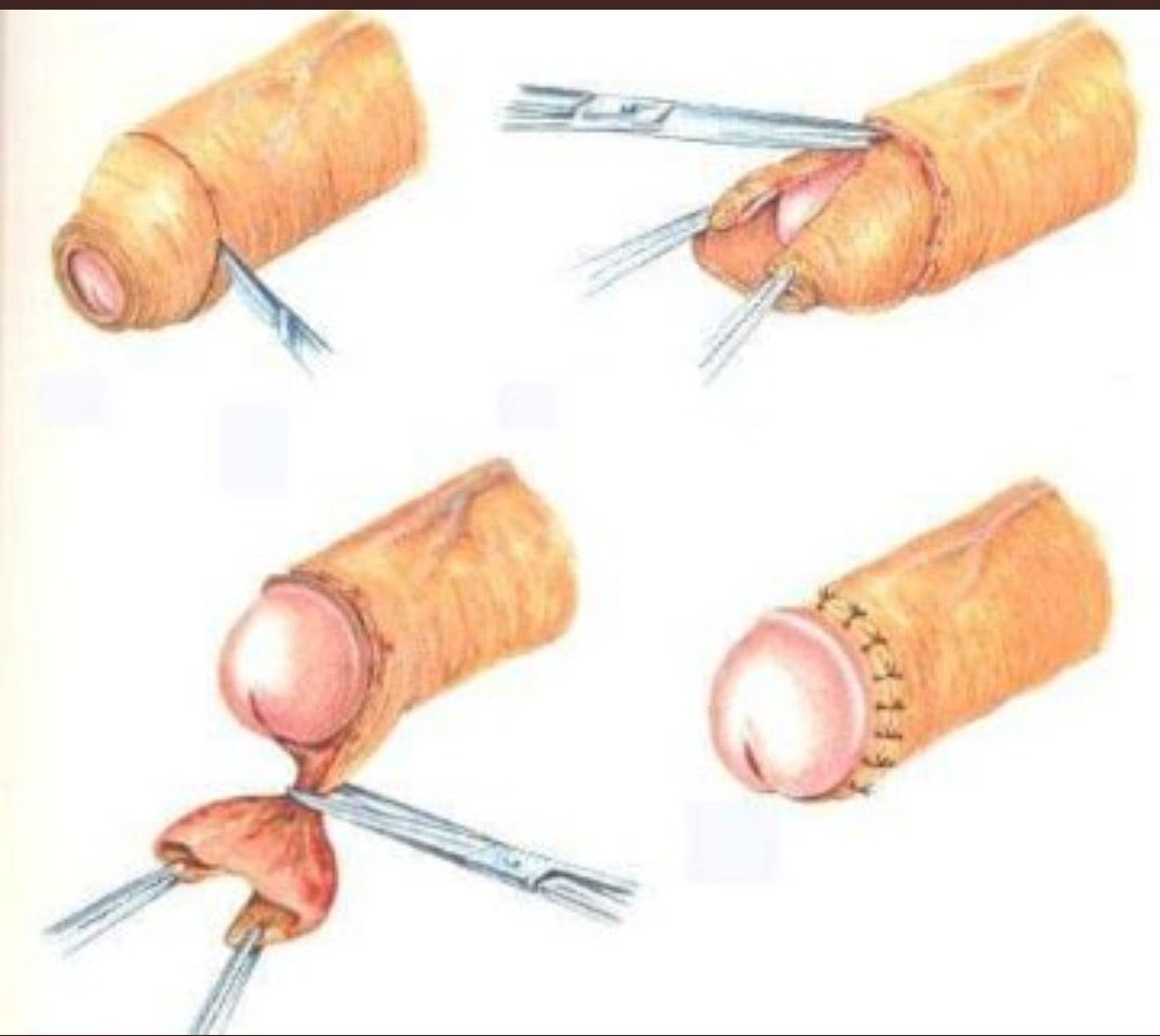 ivantresor67's tweet photo. ▶️ la circoncision à ses bienfaits et méfaits 

Comme bienfaits on a:
➡️ La circoncision diminuerait d'environ 12 fois les risques d'infections urinaires chez le nourrisson. Or, 0.7 %  des bébés sont hospitalisés dans leur première année à cause d'une infection urinaire. https://t.co/2fKYtJ2qy8