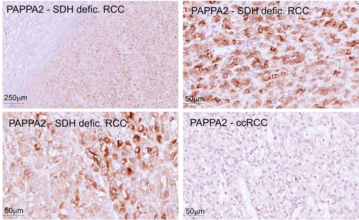 One marker of macula densa cells, PAPPA2, appears retained in all SDH deficient RCCs. As diagnosis through morphology and immunohistochemical staining is not always conclusive, positive PAPPA2 staining may prove a valuable adjunct.

#gupath