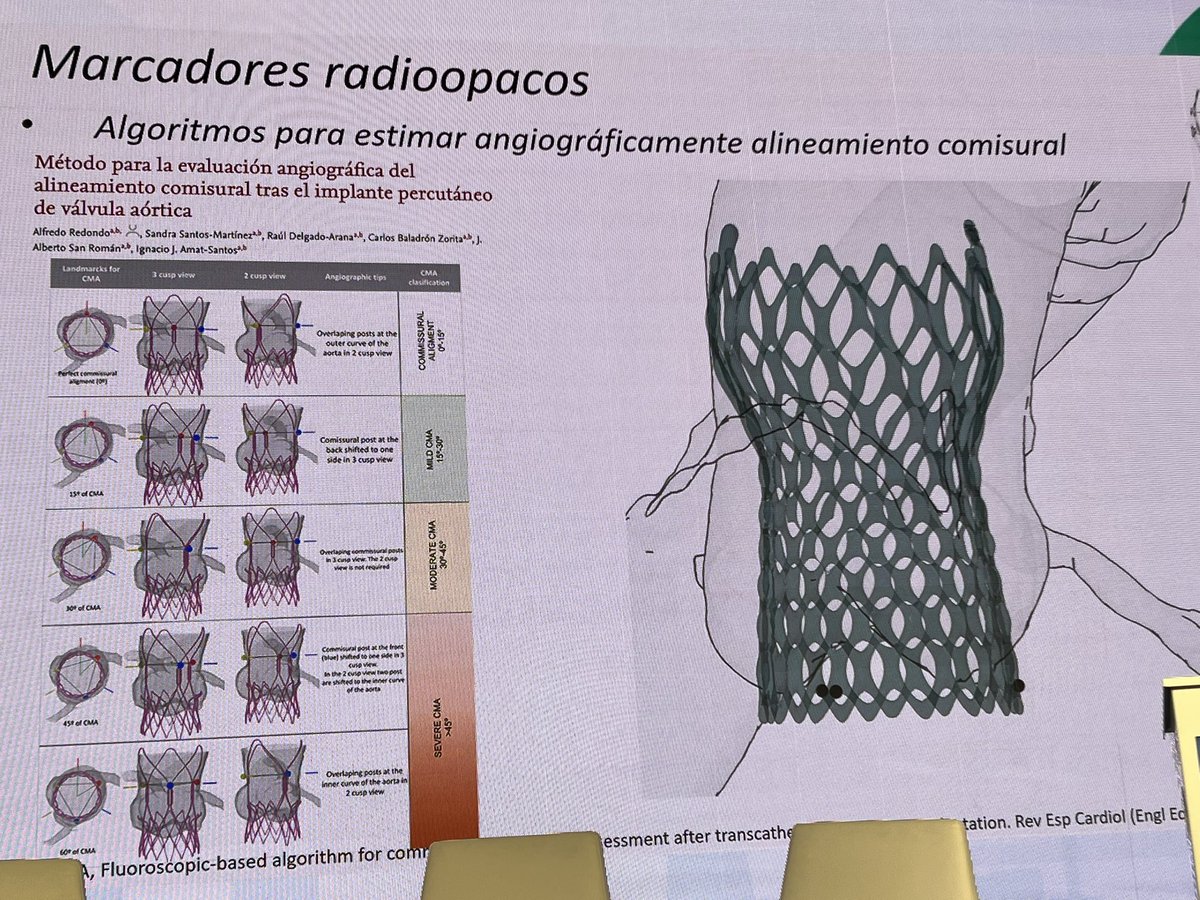 Belén Cid Alvarez (@belcid7) on Twitter photo La importancia del alineamiento comisural en el implante de TAVI #CSC22 <a href="/CSC_interv/">CSConline</a>
<a href="/AlfredoRedondoD/">Alfredo Redondo</a> <a href="/ramirotrillo/">Ramiro Trillo</a> <a href="/ignamatsant/">Ignacio J. Amat</a> <a href="/drassantos/">Sandra Santos-Martinez</a> <a href="/cardiologiaCHUS/">CARDIOCHUS</a> La importancia del alineamiento comisural en el implante de TAVI #CSC22 <a href="/CSC_interv/">CSConline</a>
<a href="/AlfredoRedondoD/">Alfredo Redondo</a> <a href="/ramirotrillo/">Ramiro Trillo</a> <a href="/ignamatsant/">Ignacio J. Amat</a> <a href="/drassantos/">Sandra Santos-Martinez</a> <a href="/cardiologiaCHUS/">CARDIOCHUS</a>