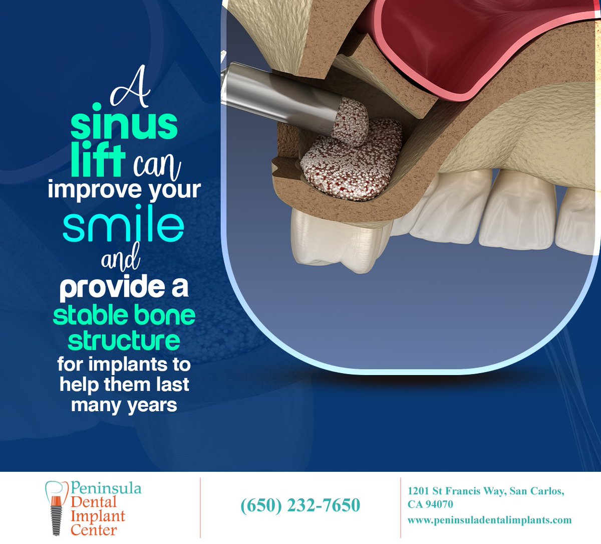 DrShivaniGupta1's tweet image. Sinus augmentation, also known as sinus lift surgery, raises the sinus floor and allows new bone to develop to provide a stable foundation for dental implants. Learn more at peninsuladentalimplants.com #sinusaugmentation #sancarlos #CA #peninsuladentalimplants