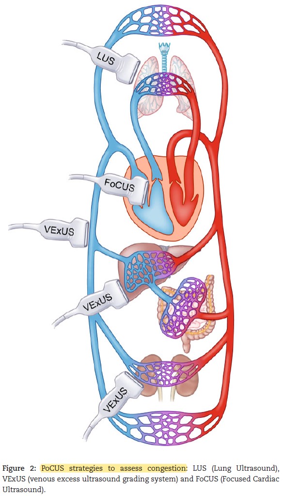 PoCUS en Nefrología 🚨

De mucha utilidad para mejorar diagnóstico (complemento, NO sustituto del examen físico) 👀

☝🏼 Importante en evaluación de volemia, 3 componentes 
✔️LUS (pulmonar)
✔️FoCUS (cardíaco)
✔️VExUS (hepatico-renal)

#NephTwitter #MedTwitter #POCUS #nephrology