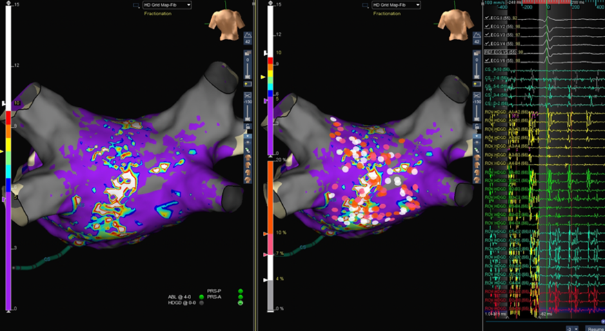 AbbottCardio's tweet photo. When this #AFib patient’s normal sinus rhythm didn’t return after cryoballoon #ablation, #HDGrid helped map &amp; identify a missed right inferior pulmonary vein &amp; restore NSR. 

Case library: https://t.co/dOl7m7cdua https://t.co/IJWk0xyhvC