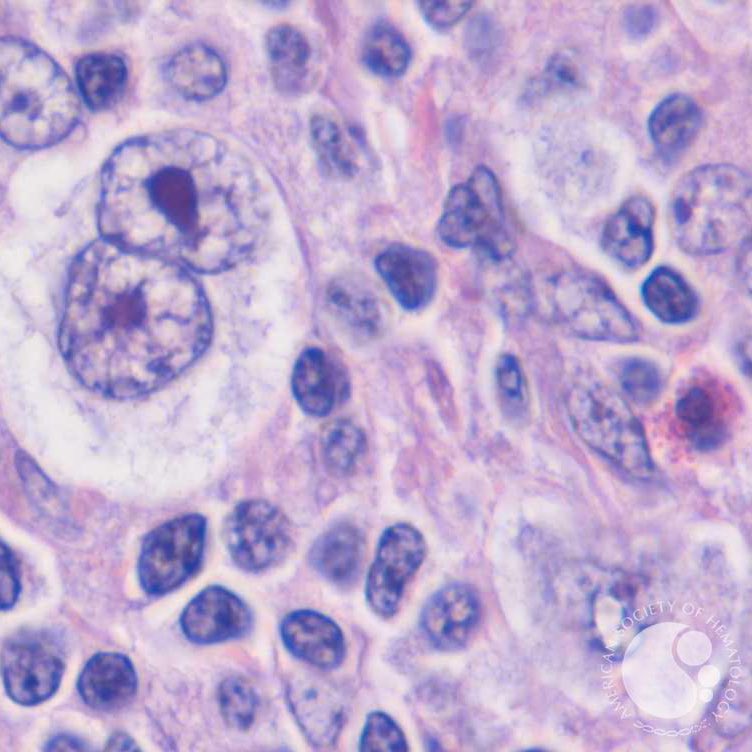 Reed-Sternberg cell- large binucleated CD30+ cell with abundant cytoplasm, characteristic of Hodgkin Lymphoma