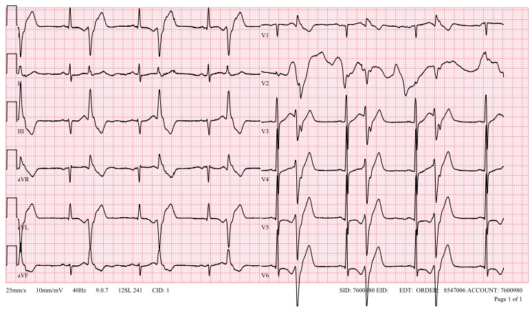 Yuksek Ihtisas Arrhythmia- Ankara City Hospital (@ach_epteam) on Twitter photo Correlation between the IRA (culprit) and SOO of the stereotypic PVC-induced VF during the infarct healing period <a href="/Mkara_EP/">Mkara</a> <a href="/ElifhandeMD/">Elif Hande Özcan Çetin</a> <a href="/AhmetKorkmaz07A/">Ahmet</a> <a href="/ozcanozeke/">Özcan Özeke</a> <a href="/prof_serkan_cay/">Prof Dr Serkan Cay</a> <a href="/drfiratozcan/">Fırat Özcan</a> <a href="/aalap/">Aalap Narichania</a> <a href="/pabsala/">Pablo Salazar, MD</a>
<a href="/DrRyanBurris/">Ryan Burris, MD</a> <a href="/DursunAras2/">Dursun Aras, Professor</a> <a href="/topaloglu_prof/">Serkan Topaloglu, MD</a>
doi.org/10.1016/j.jacc… Correlation between the IRA (culprit) and SOO of the stereotypic PVC-induced VF during the infarct healing period <a href="/Mkara_EP/">Mkara</a> <a href="/ElifhandeMD/">Elif Hande Özcan Çetin</a> <a href="/AhmetKorkmaz07A/">Ahmet</a> <a href="/ozcanozeke/">Özcan Özeke</a> <a href="/prof_serkan_cay/">Prof Dr Serkan Cay</a> <a href="/drfiratozcan/">Fırat Özcan</a> <a href="/aalap/">Aalap Narichania</a> <a href="/pabsala/">Pablo Salazar, MD</a>
<a href="/DrRyanBurris/">Ryan Burris, MD</a> <a href="/DursunAras2/">Dursun Aras, Professor</a> <a href="/topaloglu_prof/">Serkan Topaloglu, MD</a>
doi.org/10.1016/j.jacc…