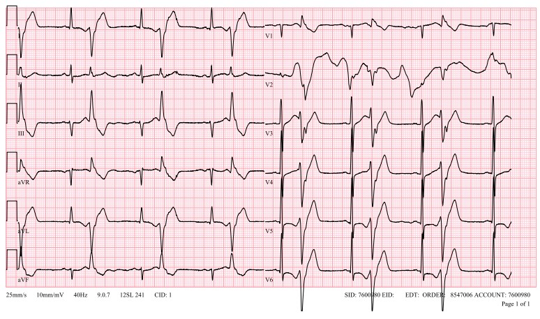 Correlation between the IRA (culprit) and SOO of the stereotypic PVC-induced VF during the infarct healing period @Mkara_EP @ElifhandeMD @AhmetKorkmaz07A @ozcanozeke @prof_serkan_cay @drfiratozcan @aalap @pabsala @DrRyanBurris @DursunAras2 @topaloglu_prof doi.org/10.1016/j.jacc…