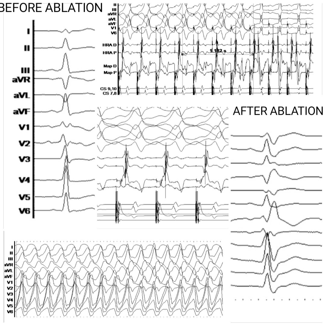 Stelios (@steliosdragasis) on Twitter photo Today's successful ablation procedure of a left lateral accessory pathway with ARP<210 msec causing preexcited AVRT in a 19-year old male patient in @Athens_Euroclinic, together with Dimitrios Athanasias. Excellent technical support by <a href="/CosmoValkanas/">Kosmas Valkanas</a> using Carto3 3D system. Today's successful ablation procedure of a left lateral accessory pathway with ARP<210 msec causing preexcited AVRT in a 19-year old male patient in @Athens_Euroclinic, together with Dimitrios Athanasias. Excellent technical support by <a href="/CosmoValkanas/">Kosmas Valkanas</a> using Carto3 3D system.