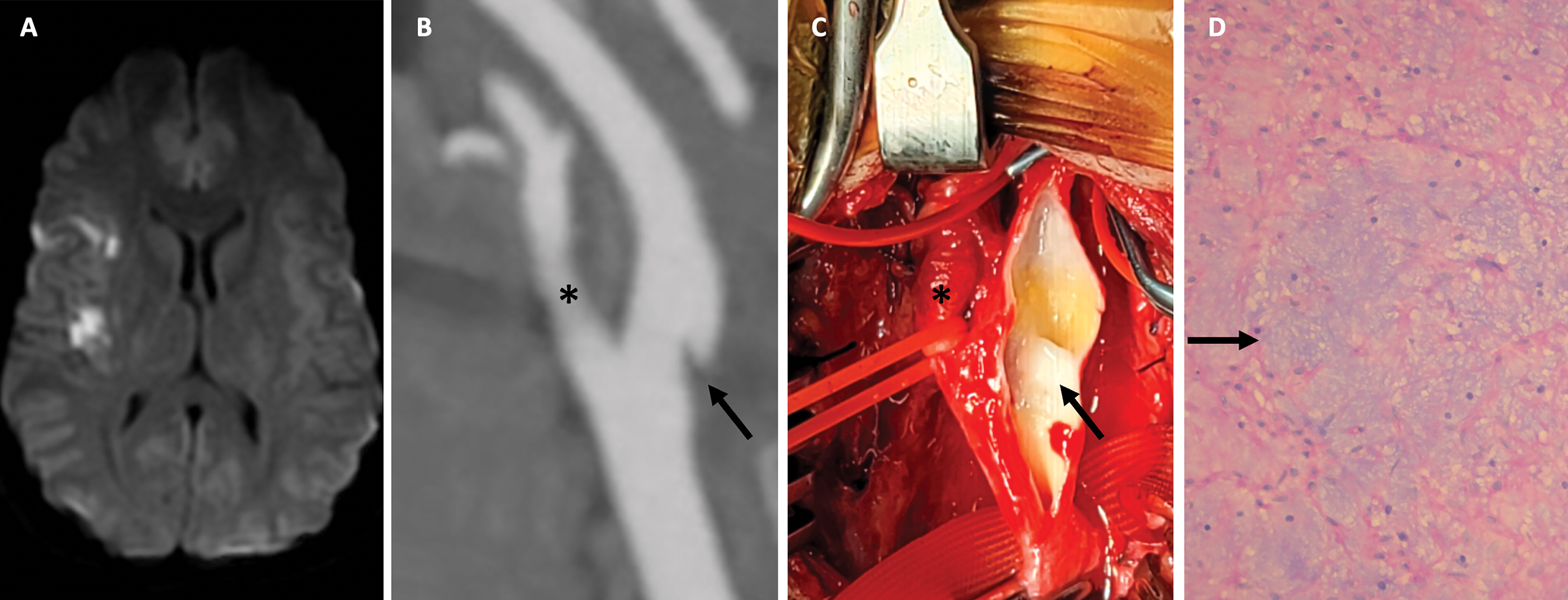 radiology-on-twitter-diffusion-weighted-mri-scan-shows-acute-right