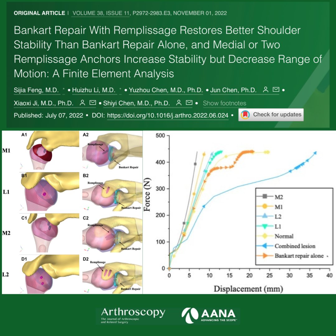 Off-Track Shoulder Instability:
Finite element analysis models of a critical Hill Sachs defect prove that adding Remplissage improves stability vs Bankart alone, but medial or 2 anchor configurations can over-restrain.

ow.ly/matX50LBLt9