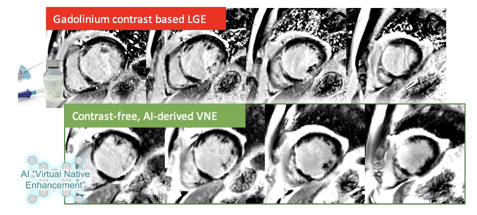 Fantastic to see our Virtual Native Enhancement (#VNE) work published in <a href="/CircAHA/">Circulation</a>! 

#VNE is a novel #whyCMR method using #AI to visualize &amp; quantify myocardial infarction scar, without the need for gadolinium contrast. 

Led by myself &amp; <a href="/QiangZhangAiCmr/">Qiang Zhang</a> <a href="/MayooranShan/">Mayooran Shan</a> 

🧵 1/n