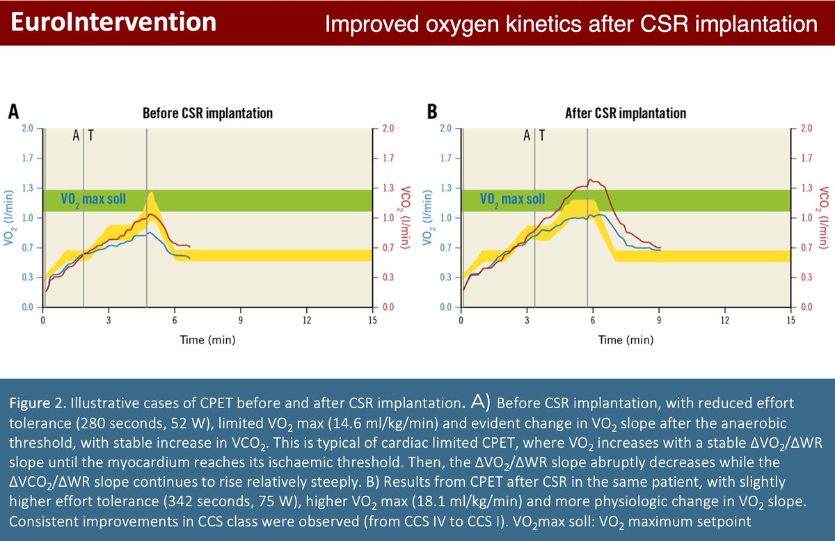 EuroInterventio's tweet photo. This study of patients with refractory angina, showed that the application of the coronary sinus Reducer was  associated with significant clinical benefits and with objective improvements in VO2 kinetics and effort tolerance. #EIJBestOf  https://t.co/XcJPD0rb2w https://t.co/UY9DYkPQ9C