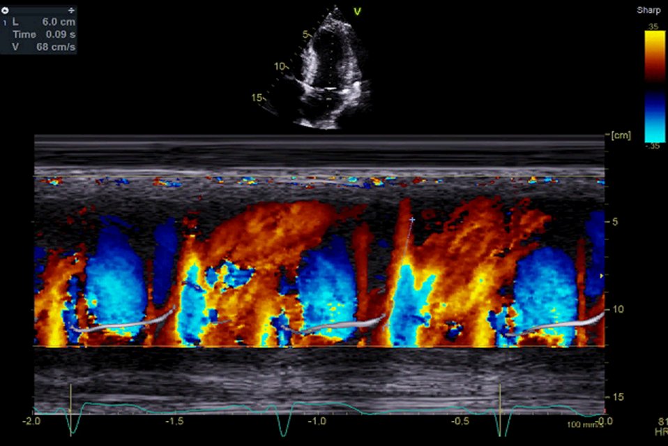 How many people use MV flow propagation velocity (Vp) routinely? The data suggest it's preload independent and a marker of diastolic dysfunction in AF. We use a cut-off of Vp <45cm/s to suggest impaired LV relaxation. #echofirst <a href="/echotalk/">EchoTalk Echocardiography</a> <a href="/echocardiac/">Echocardiography</a> <a href="/EchoCases/">Echocardiography</a> <a href="/The_Echo_Nerd/">Katherine Collins MSc FBSE</a>
