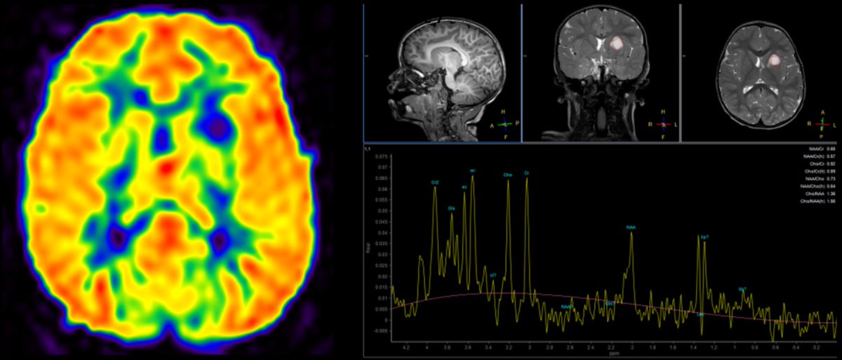 #AJNRcom >> November 2022, Week 2 >> A 3-year-old girl with developmental delay presents with seizures refractory to multiple antiepileptics. View the case at ow.ly/54Ml50LGeYm