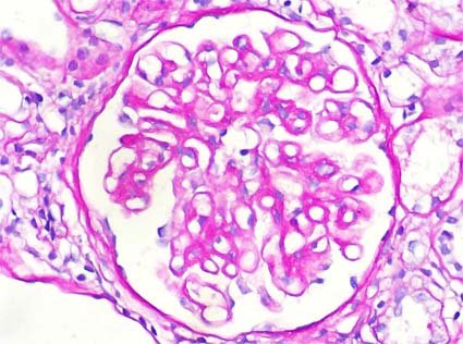 saliiiiieta's tweet photo. qué patrón de lesión glomerular eres🔬  (aprovechando mi rotación de anatomía patológica): https://t.co/TbZZwfbtKG
