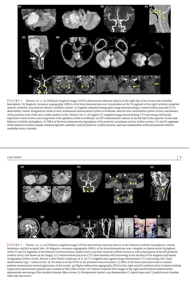 nihaal08's tweet photo. Cryptogenic posterior circulation stroke in children..Important to review CVJ anomalies..and indication based diagnostic approach..
@Prasanthi2010 @LokeshLingappa https://t.co/jCwkpNyS4P
#stroke #childstroke #pedsneurorad #pedineurorad #bowhunterssyndrome https://t.co/46aOnefbxr