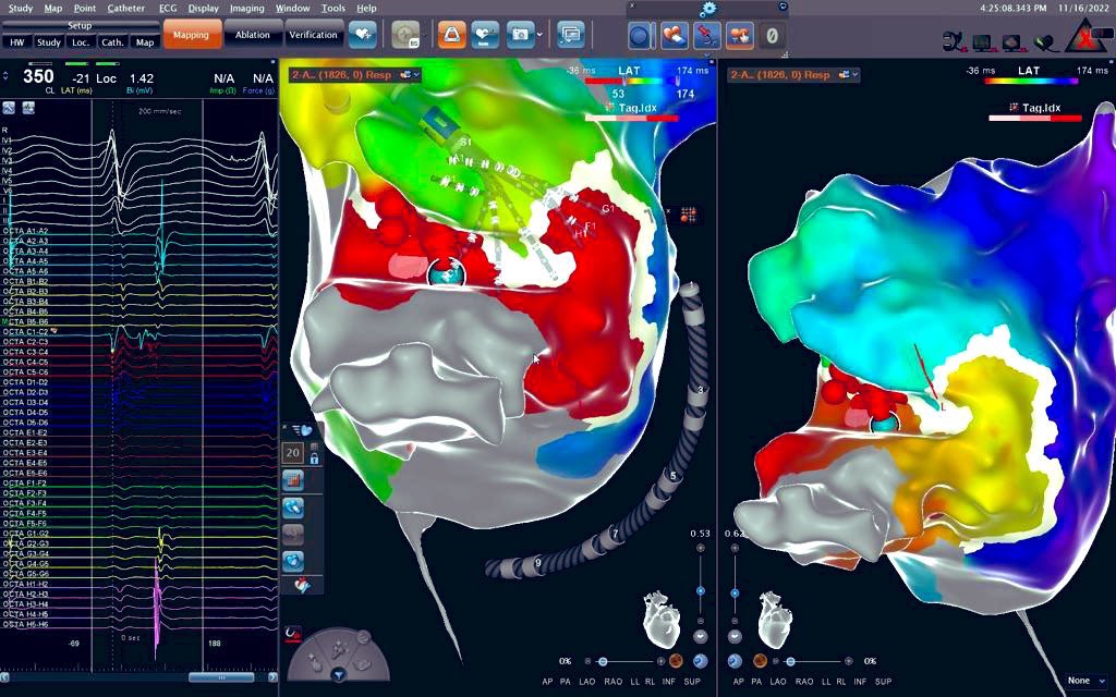 Laila_G's tweet photo. Pretty nice case performed with Openwindow CARTO 3 system and octapolar catheter. WPW left AL accessory pathway ablated through transeptal puncture near base of left appendage. @tebagf @MoisesManero #ePeeps #CardioTwitter https://t.co/YaAh3pxAIz