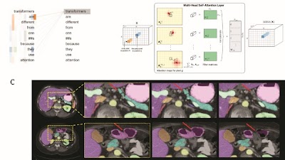 Radiology_AI's tweet photo. The challenges of training a very large medical imaging #transformer model https://t.co/KrJmqfsf2s @StanfordRad @StanfordMed #BERT #ML #MachineLearning #FSS22 https://t.co/AuaEIzJJ5C