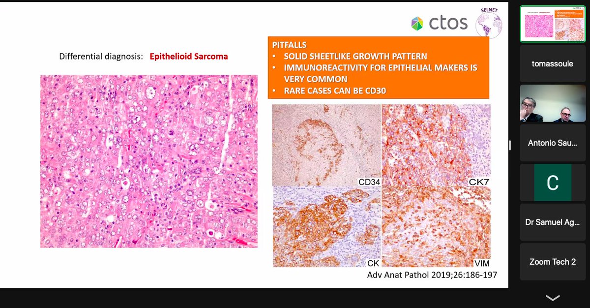 Presntantion of "The spectrum of vascular tumors: Pitfalls in Histologic Diagnosis" by <a href="/haydeecaros/">Haydeecaros@</a> 👏👏