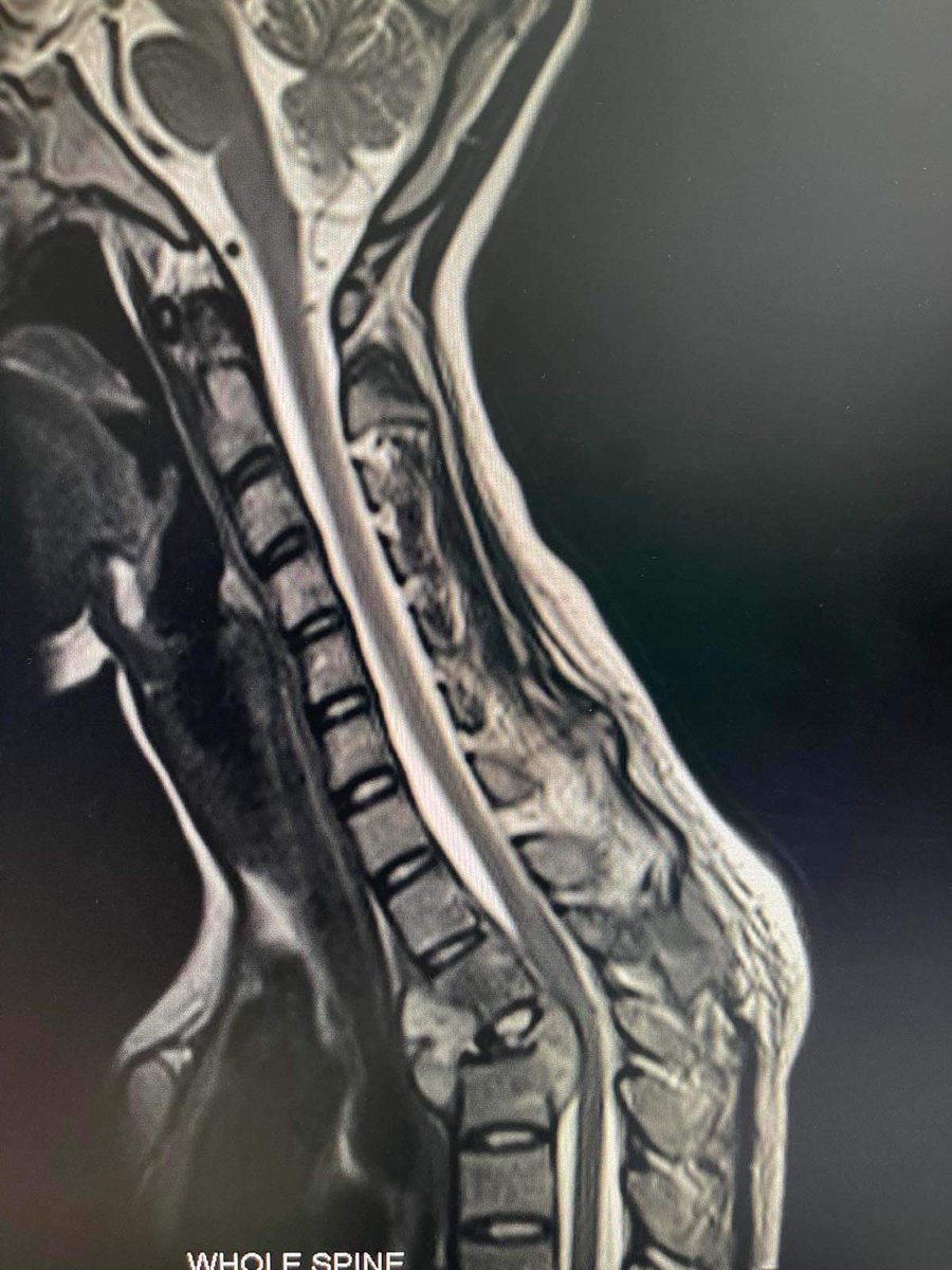 marksantos0012's tweet photo. @indaysara sir mam, manghihingi lang po kmi ng tulong para sa pinsan ko na nakaconfine ngaun sa Philippine Orthopedic, Anne Nicole Pepito po ang pangalan niya, need mo syang malagyan ng bakal sa kanyang spine, need ndaw po maoperahan sa lalong madaling panahon, halos 2weeks nadin po sya https://t.co/9CwBcX30as