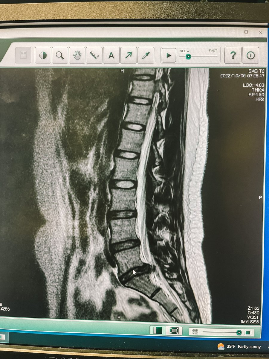 annaljoness's tweet photo. To all the doctors and future medical care providers look at this beauty… What would your advice be for treating this lovely herniated L5-S1 disc of mine? https://t.co/5yLsugGXGt