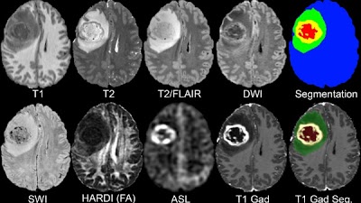 Radiology_AI's tweet photo. The @UCSF Preoperative Diffuse #Glioma MRI Dataset https://t.co/qPOI6lY6i0 @RadRudie @ujjwalbaid0408 @SpyridonBakas #BrainTumor #AI #MachineLearning #FSS22 https://t.co/tObIu5oVsL